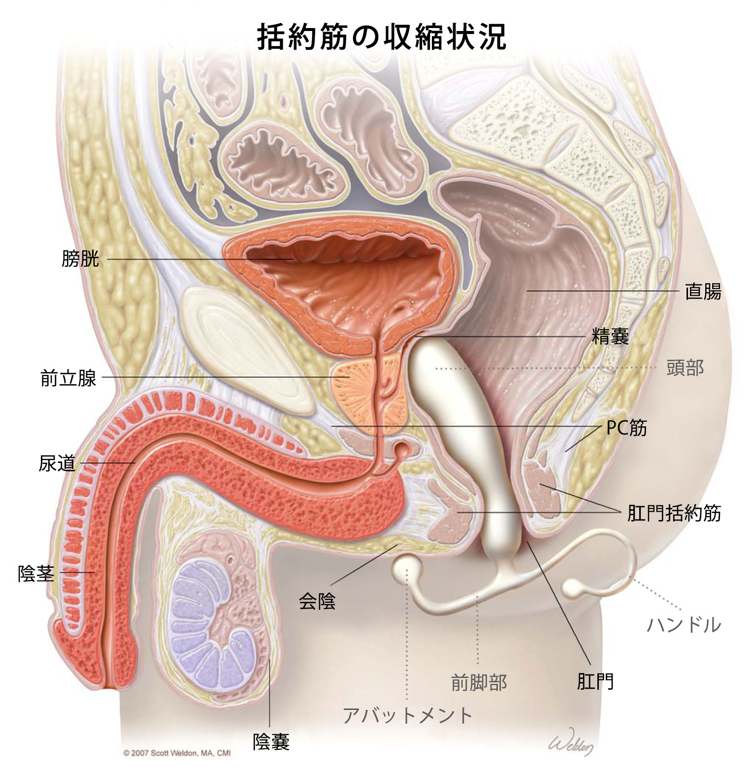 アネロス挿入断面図