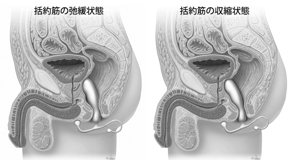 括約筋の弛緩状態と収縮状態のアネロス