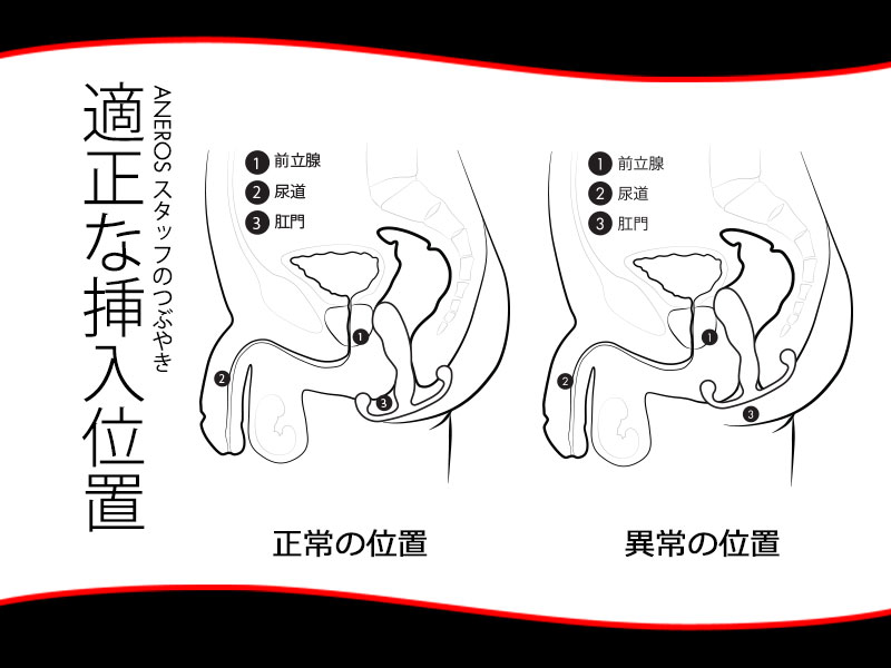 必見！アネロス適正挿入位置