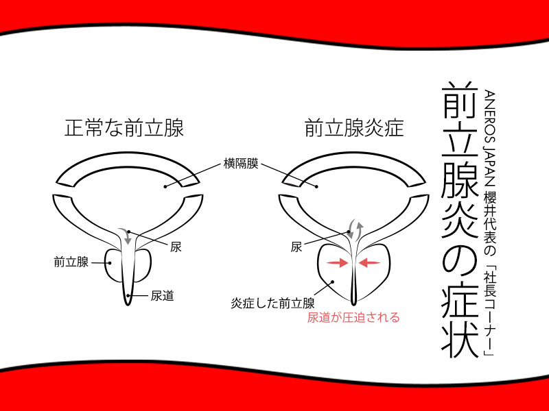 前立腺炎の症状