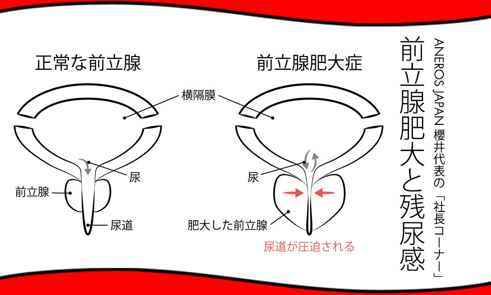 前立腺肥大による残尿感発生の仕組み 前立腺肥大による残尿感発生の仕組み